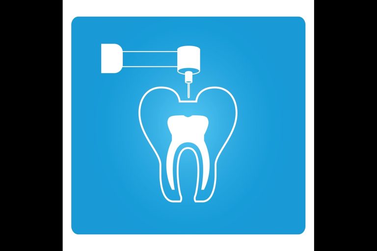 Root Canal: What It Is, When It’s Needed & How to Prevent It