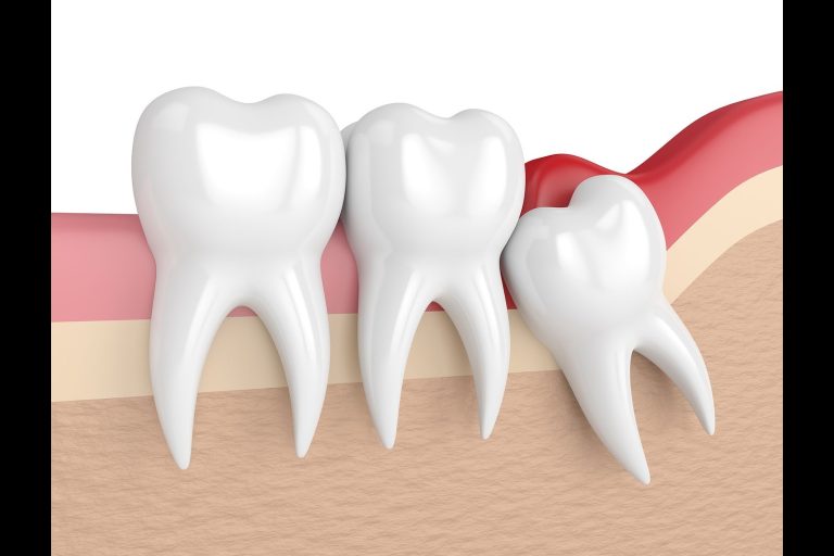 What Is Pericoronitis And Can Antibiotics Treat And Prevent It?
