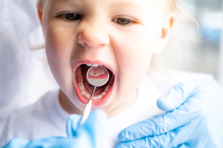 Children’s Dental Infections: When Antibiotics Are Considered