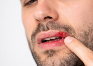 cold sores