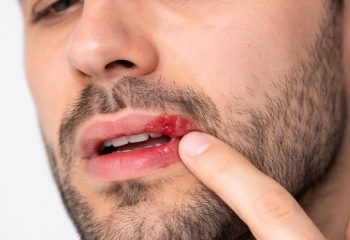 Cold-sores.jpg